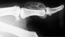 L Osteochondromatose Synoviale Du Poignet Et Des Segments Digitaux 39305863