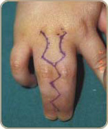 Syndactylie3
