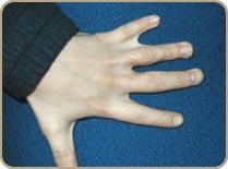 Syndactylie4